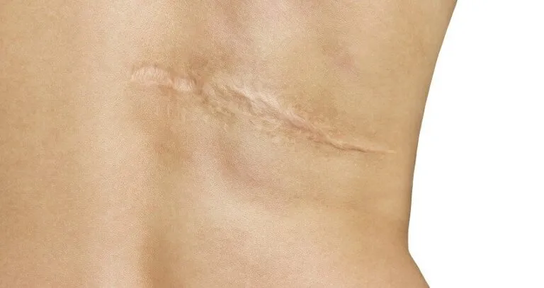 What Causes White Scars and Treatment Options