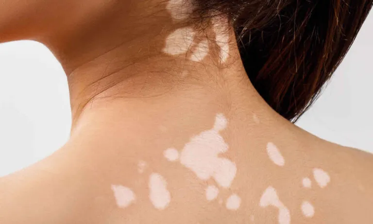 Causes of Skin Discoloration